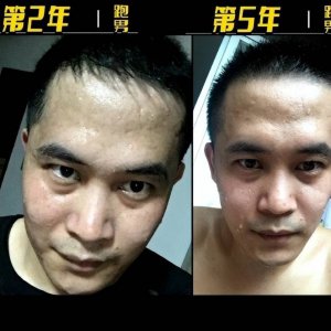 红斑狼疮患者的榜样！男子患红斑狼疮近5年 为“